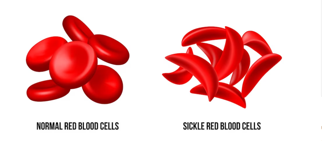 Signs of sickle cell disease in newborn babies