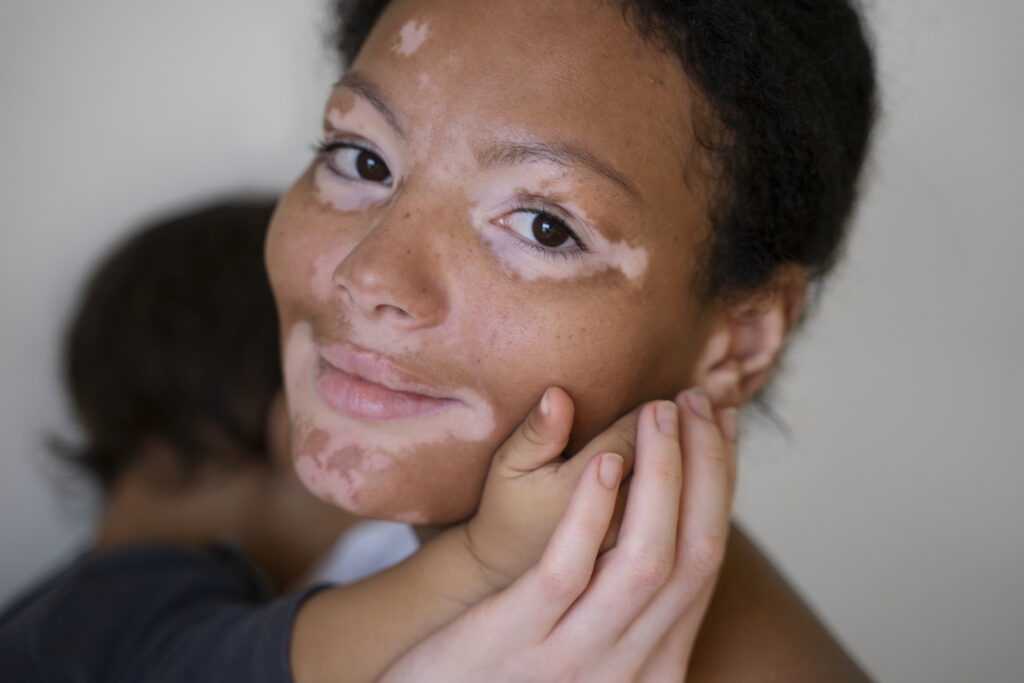What is the best treatment for vitiligo
